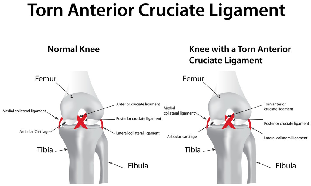 ACL Reconstruction (To Treat an Anterior Cruciate Ligament Tear