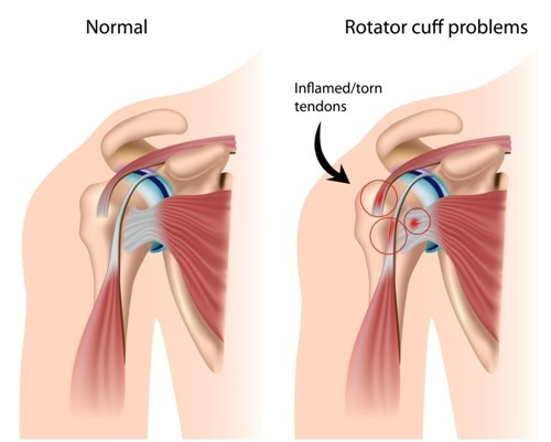 Rotator Cuff Repair