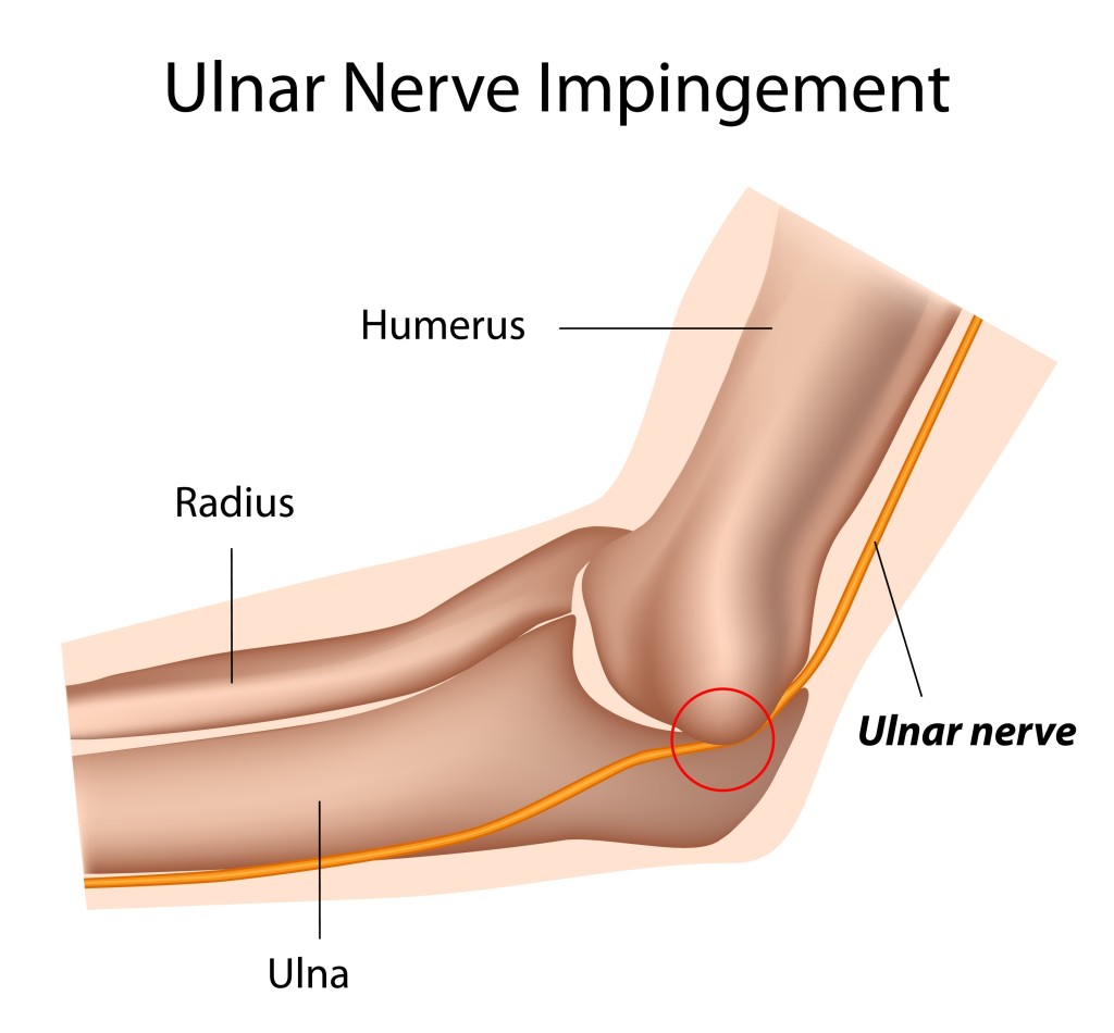 Ulnar Nerve Impingement